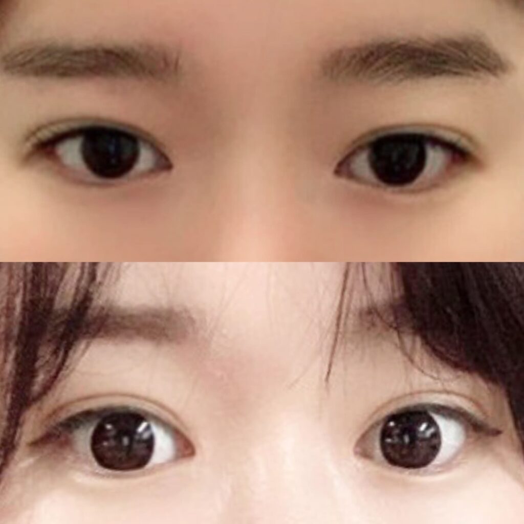 Recovery After Eyelid Lift in Korea