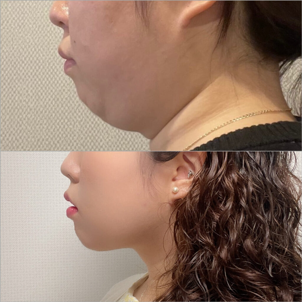 Recovery After Face Liposuction in Korea