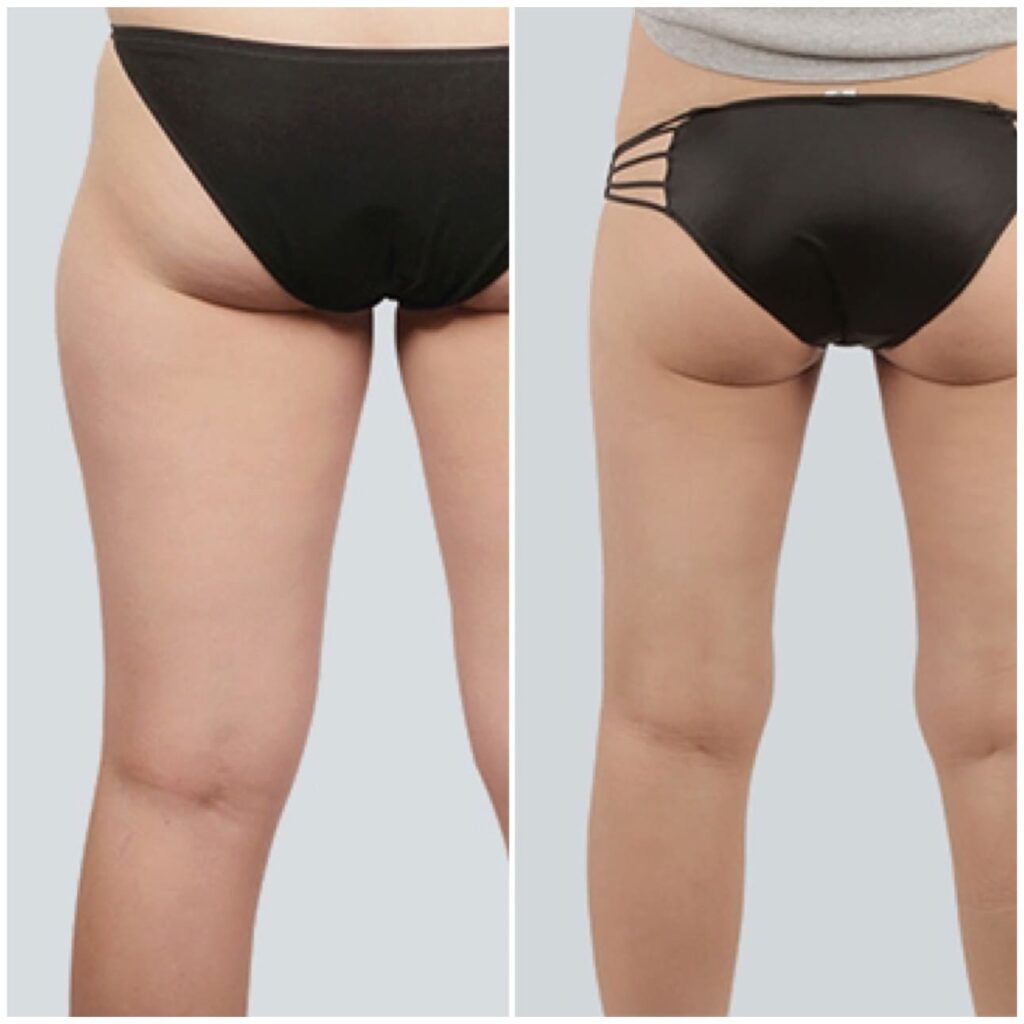 Recovery After Leg Liposuction in Korea