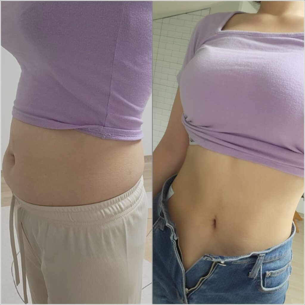 Recovery After Liposuction in Korea