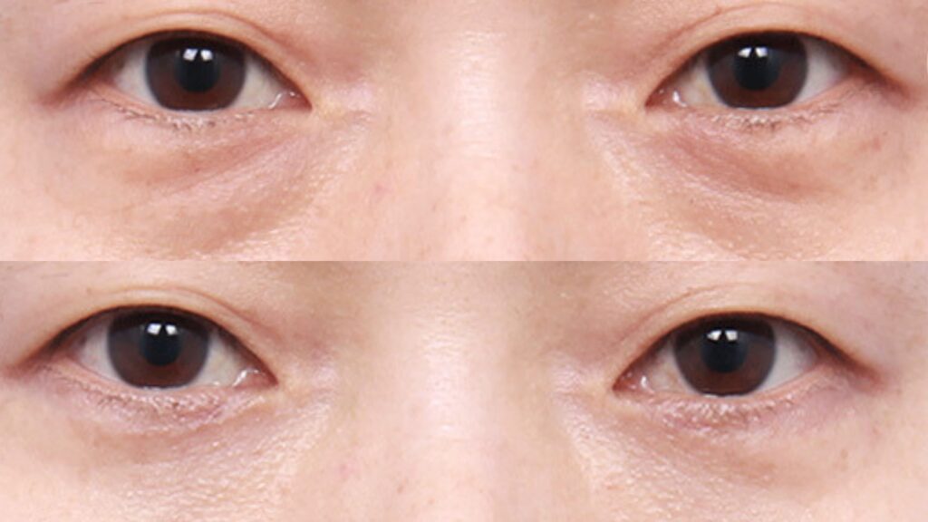 Recovery After Lower Blepharoplasty in Korea