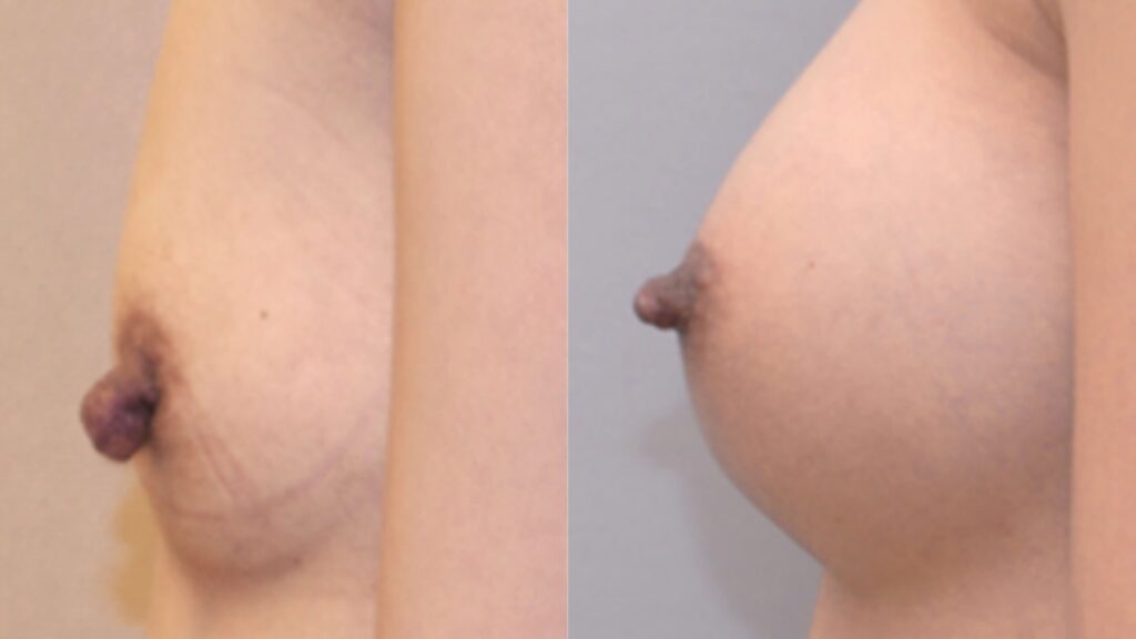 Recovery After Nipple Reduction in Korea