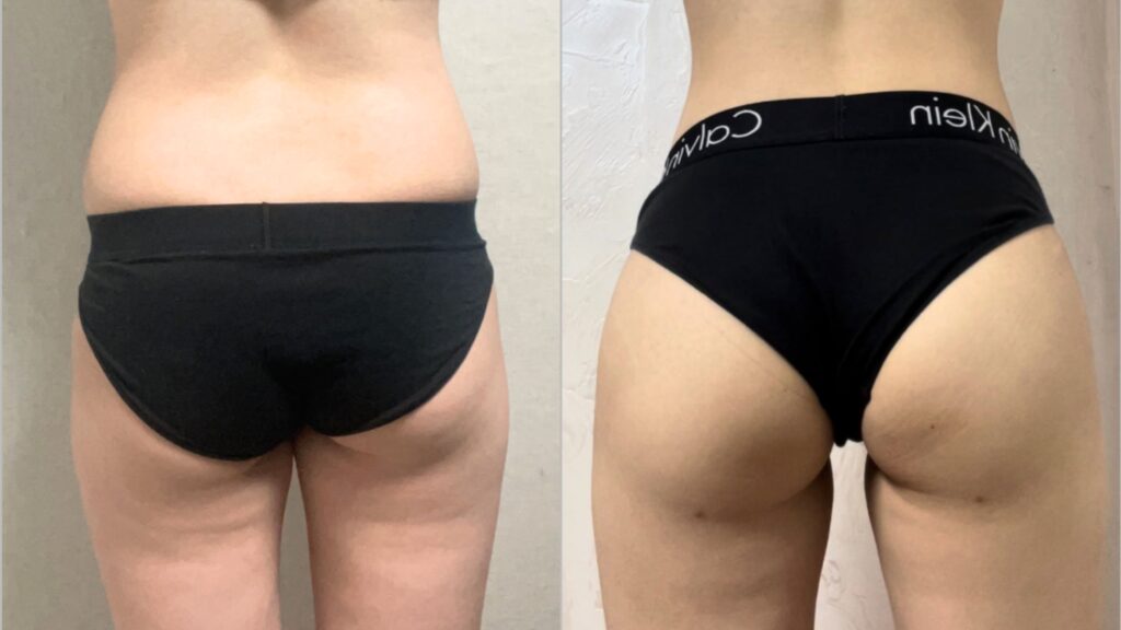 Recovery Period After Buttock Lipofilling in Korea