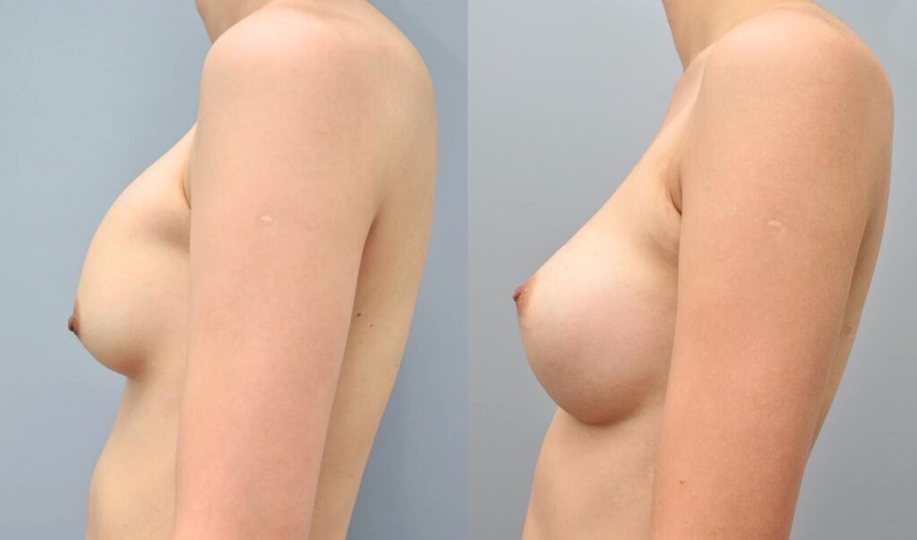 Recovery Timeline after Breast Enlargement in Korea