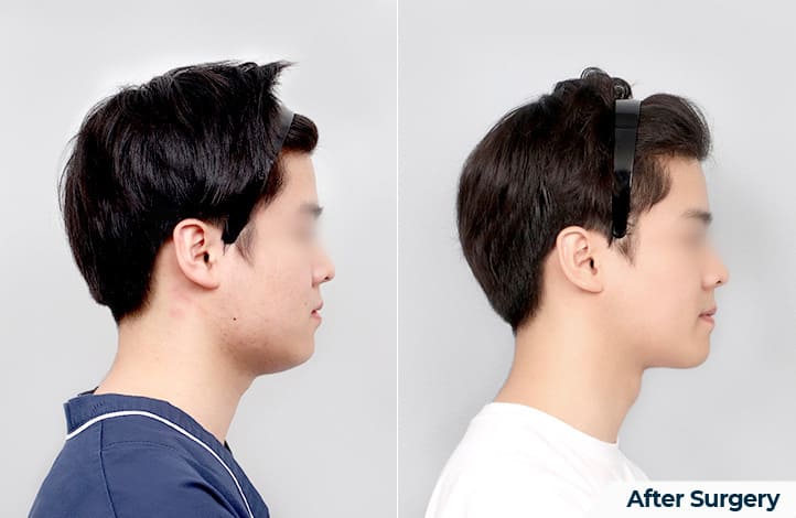 Recovery Tips After Chin Correction in Korea