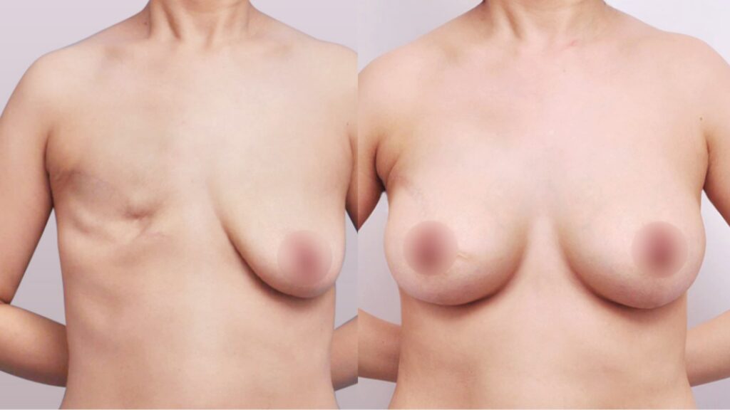 Recovery after Breast Reconstruction Surgery in Korea