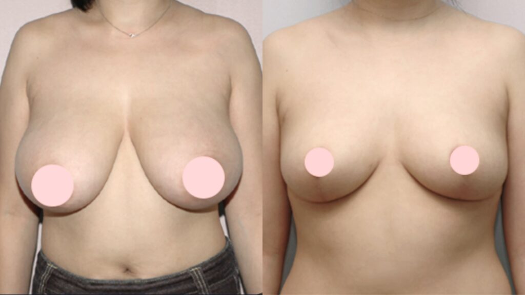 Recovery from Breast Reduction Operation