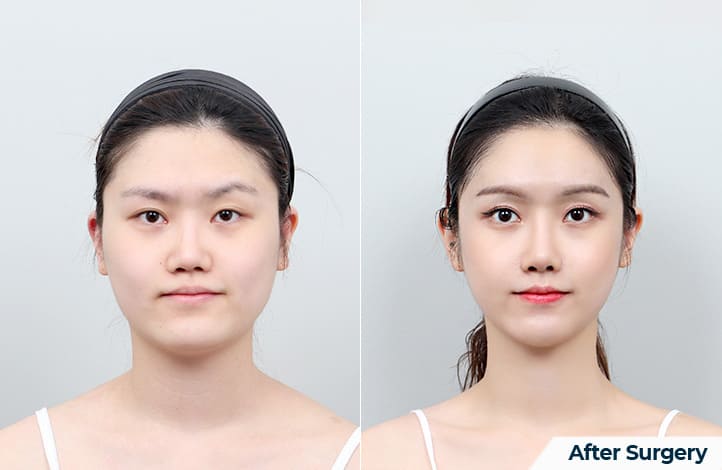 Reducing Jaw Size_ Effects and Results in Korea