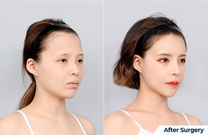 Reducing Jaw Volume for Facial Delicacy in Korea