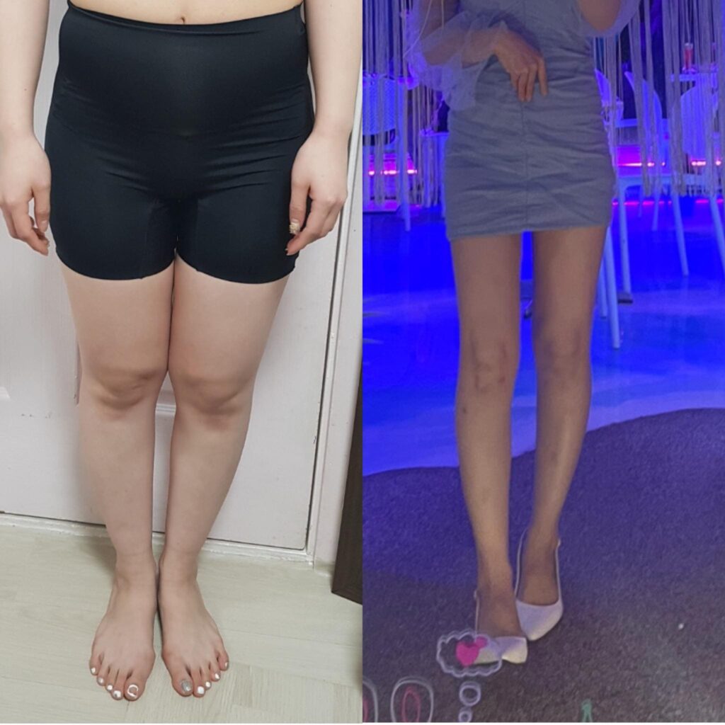 Reducing Thigh Volume Through Liposuction in Korea