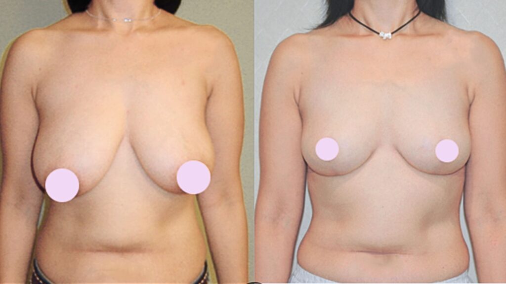 Reduction Mammoplasty Process