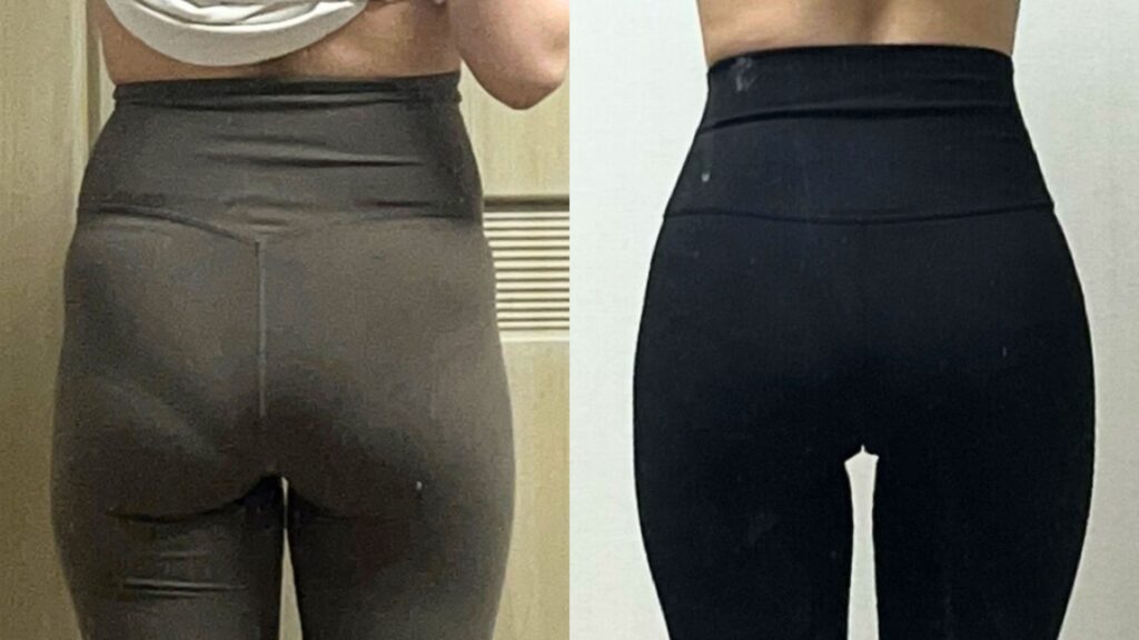 Rehabilitation After Buttock Lipofilling in Korea