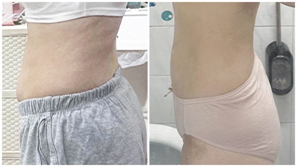 Rehabilitation after Abdominal Liposuction in Korea