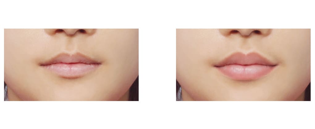 Restoring Natural Lip Beauty in Korea