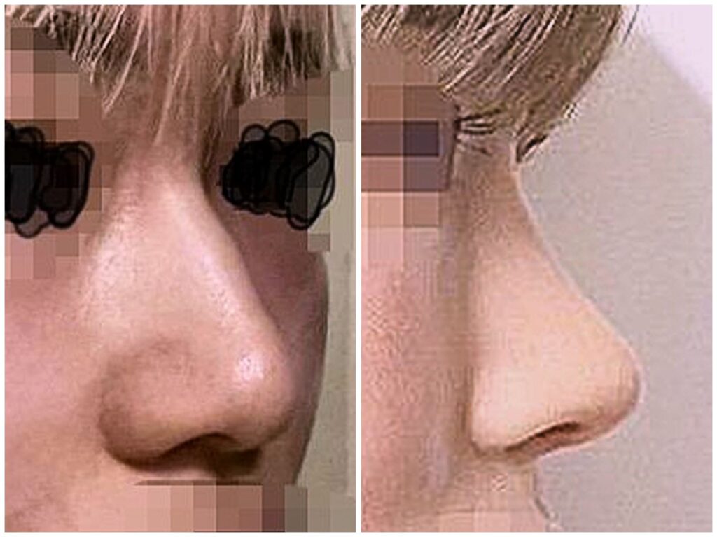 Restoring Nose Shape_ Rhinoplasty in Korea