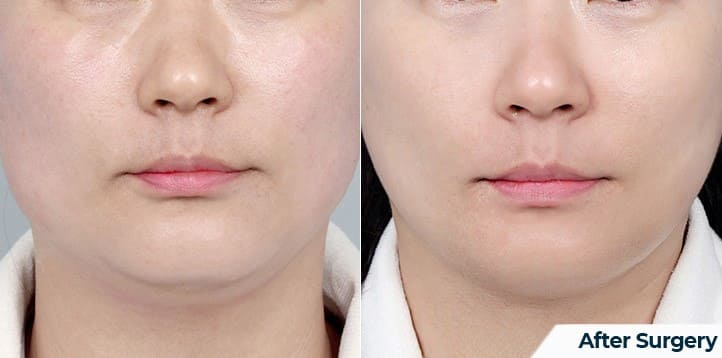 Results of Face Lifting with Korean Cosmetic Technologies