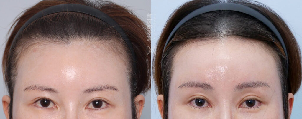 Results of Forehead Reduction Surgery in Korea