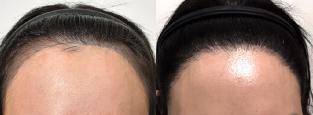 Results of hair transplant for women in Korea