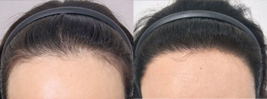 Return to feminine beauty with hair transplant in Korea