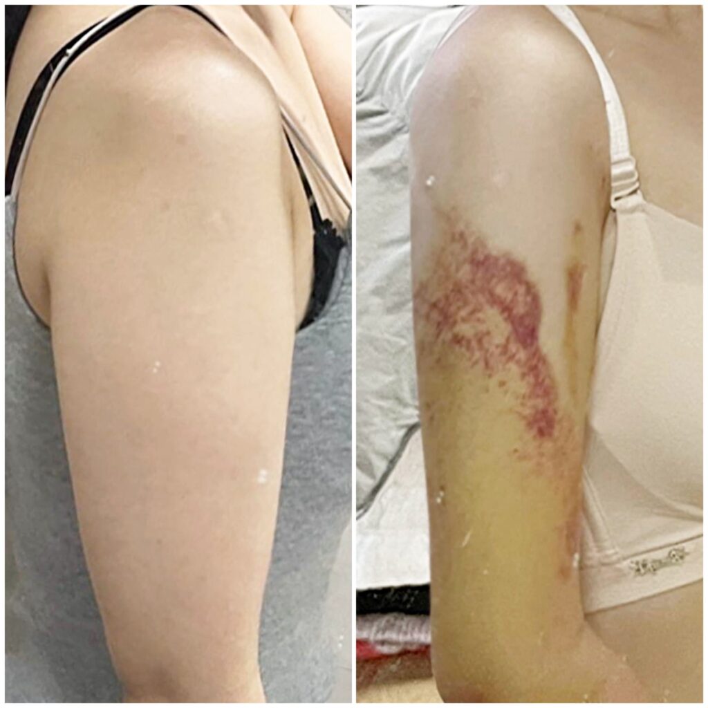 Reviews on Arm Liposuction in Korea