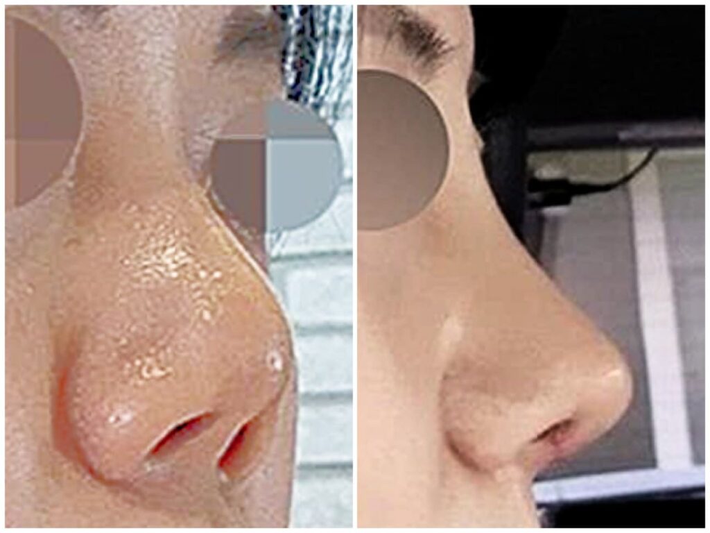 Revision Rhinoplasty_ Anesthesia Options in Korea