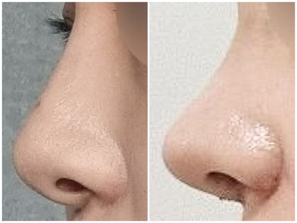 Revision Rhinoplasty_ Care Instructions in Korea