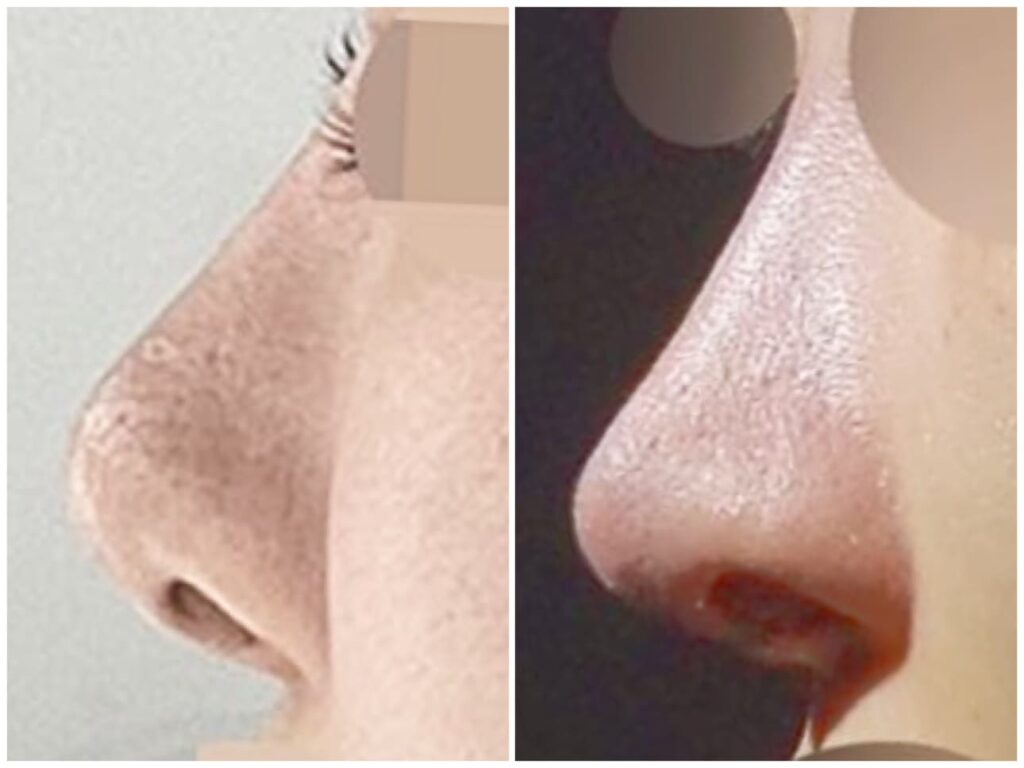 Revision Rhinoplasty_ Correction Alternatives in Korea