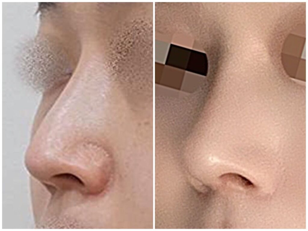 Revision Rhinoplasty_ Crucial Aspects in Korea