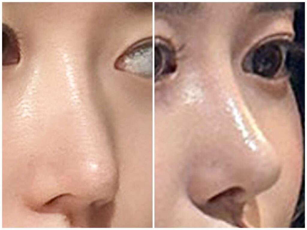 Revision Rhinoplasty_ Discussing Expectations and Reality in Korea