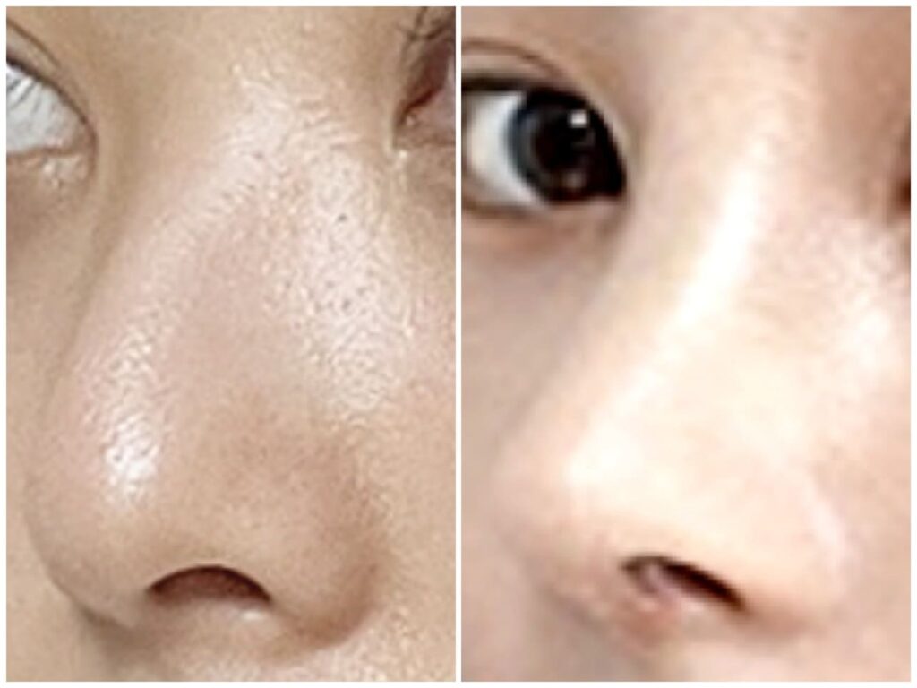 Revision Rhinoplasty_ Enhancing Quality of Life in Korea