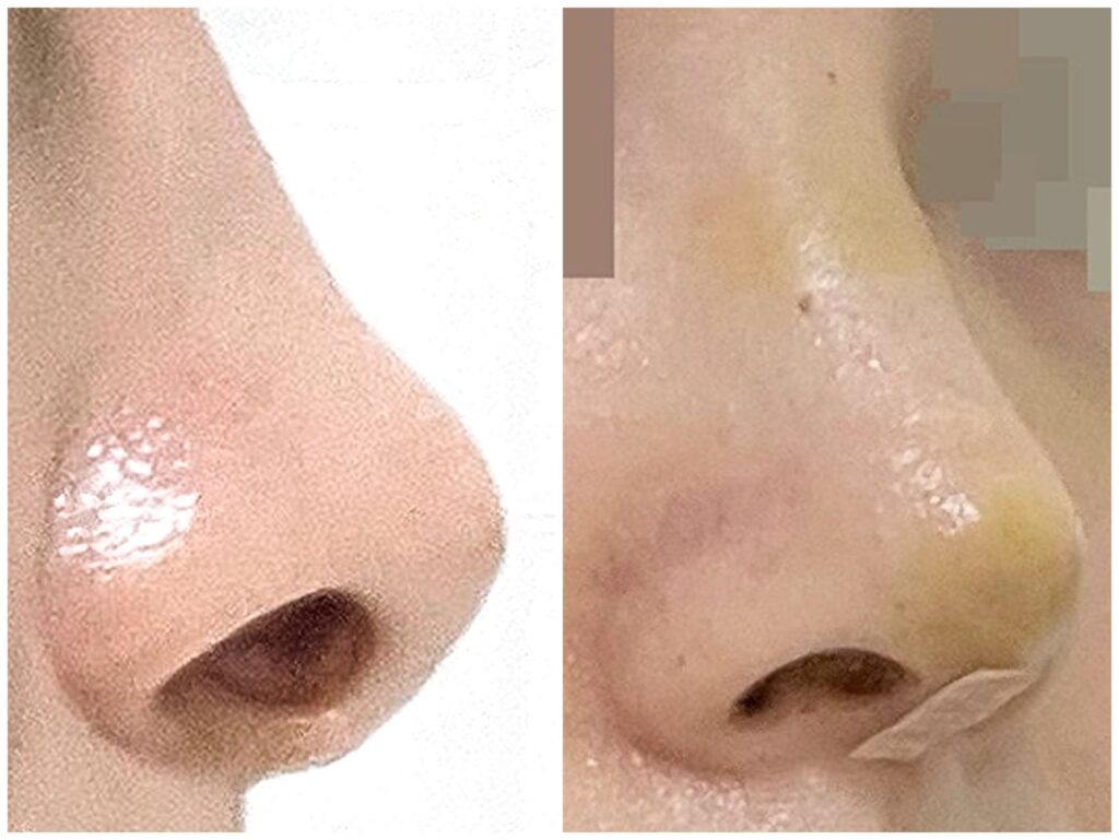 Revision Rhinoplasty_ Key Advantages in Korea