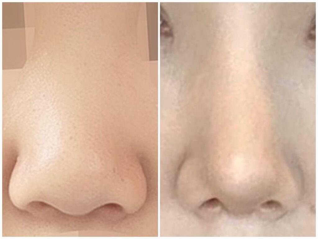 Revision Rhinoplasty_ Long-Term Outcomes in Korea