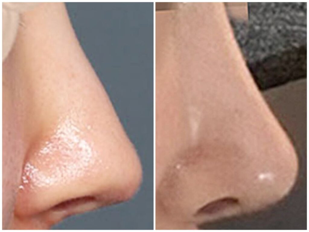 Revision Rhinoplasty_ Modern Aesthetic Surgery Options in Korea