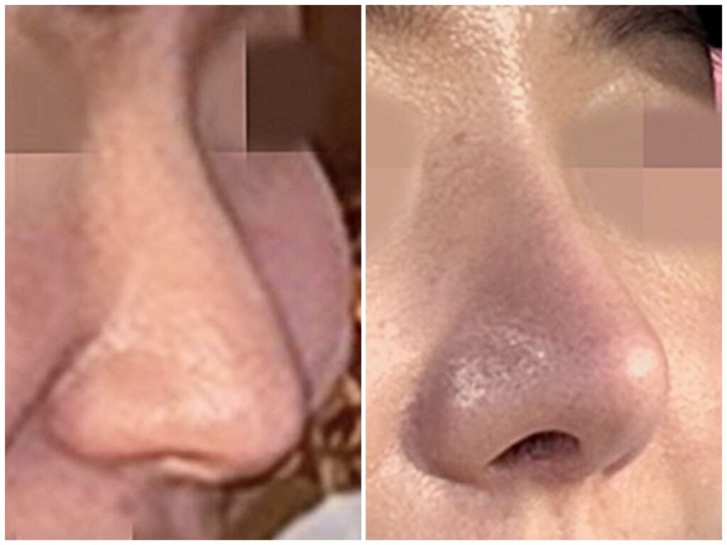 Revision Rhinoplasty_ Modern Techniques in Korea