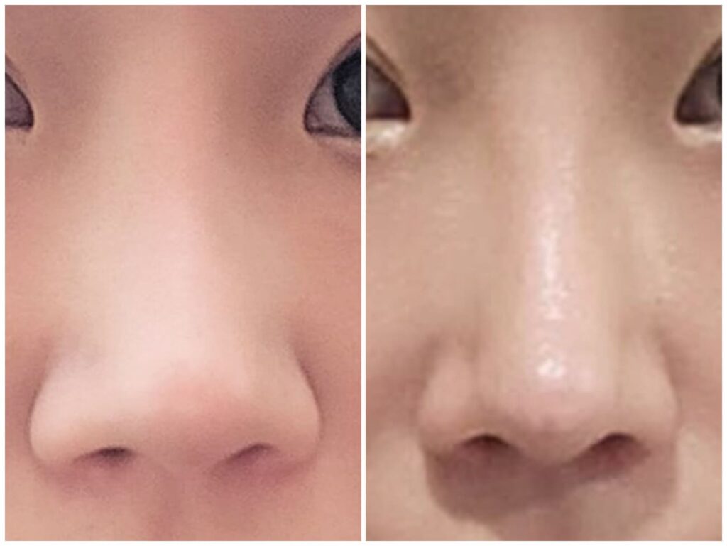 Revision Rhinoplasty_ Patient Consultation in Korea