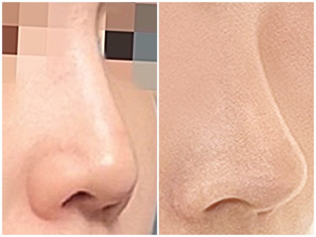 Revision Rhinoplasty_ Preoperative Preparation in Korea