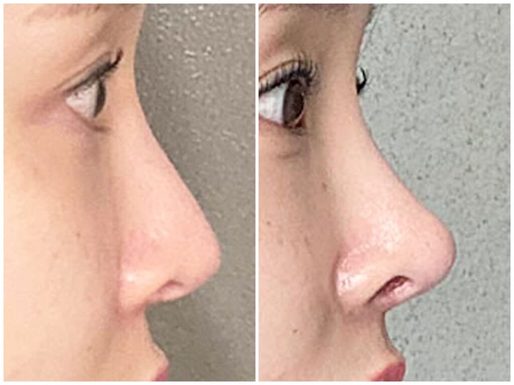 Revision Rhinoplasty_ Preparing for the Procedure in Korea