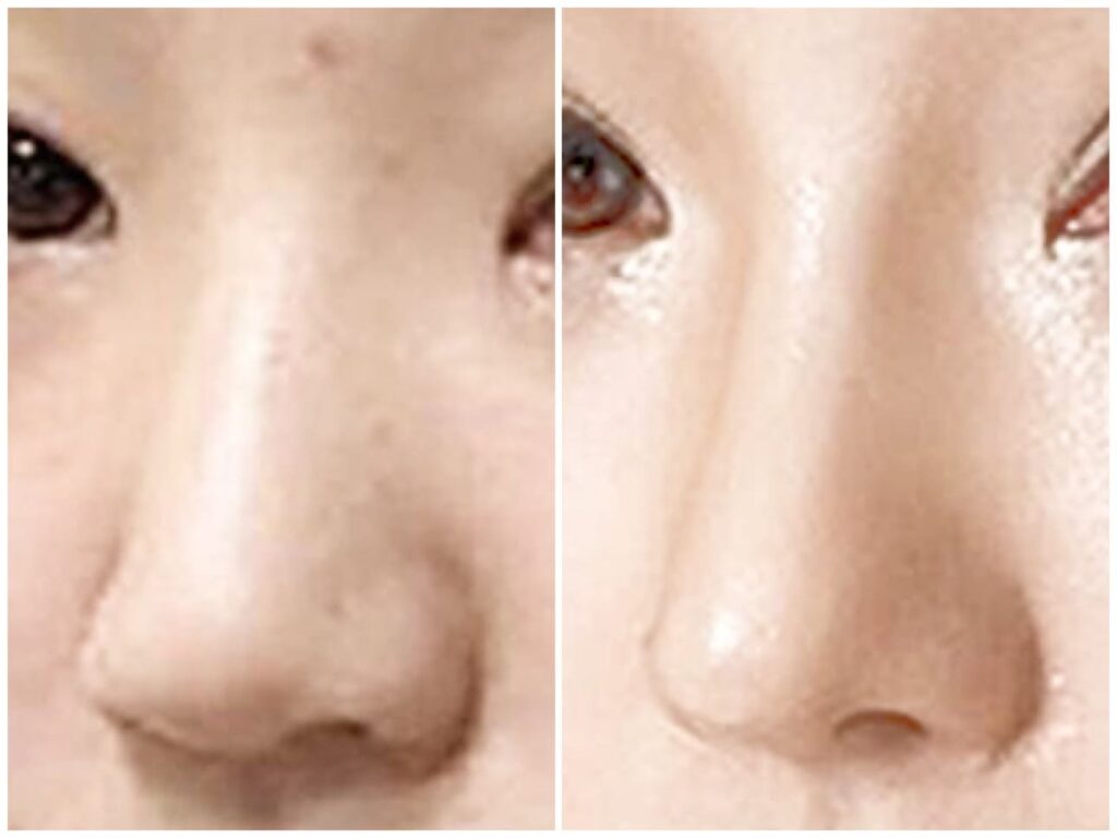 Revision Rhinoplasty_ Prices and Financial Aspects in Korea