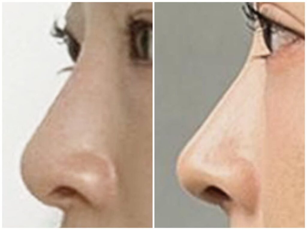 Revision Rhinoplasty_ Timing Considerations in Korea