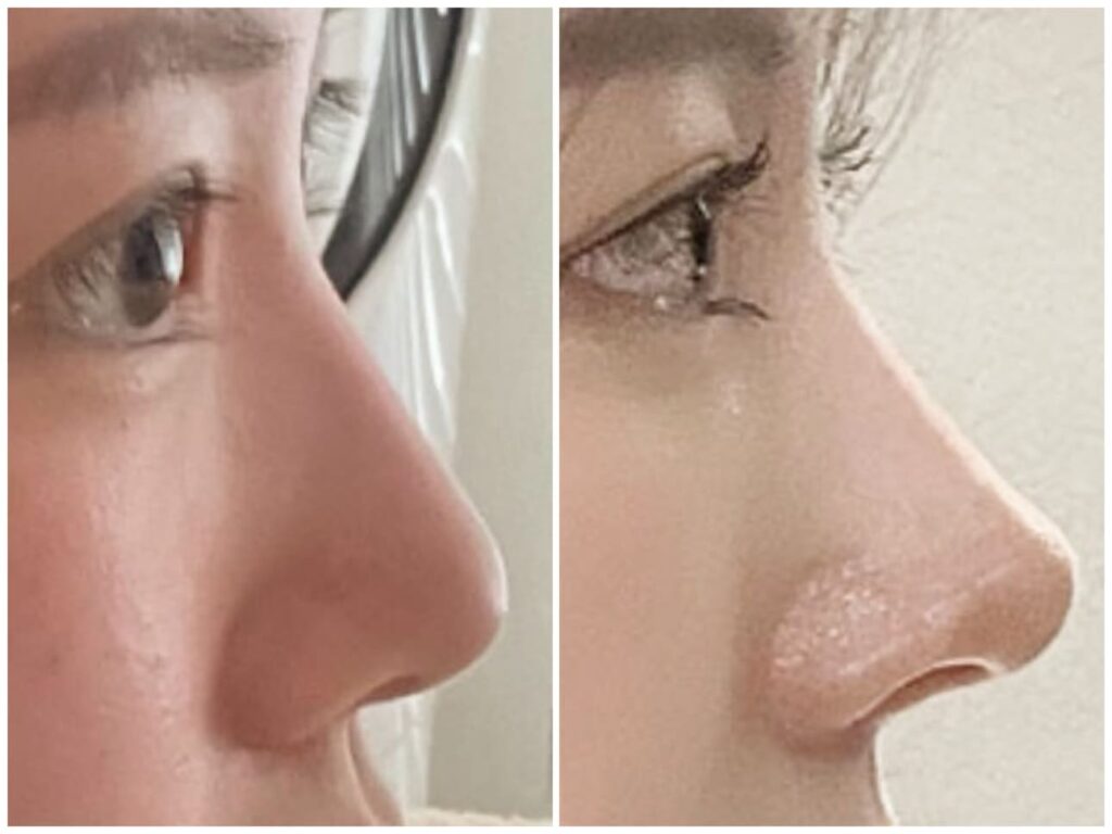 Rhinoplasty Procedure in Korea