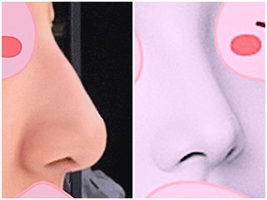 Rhinoplasty for Dorsal Hump Removal_ Key Points in Korea