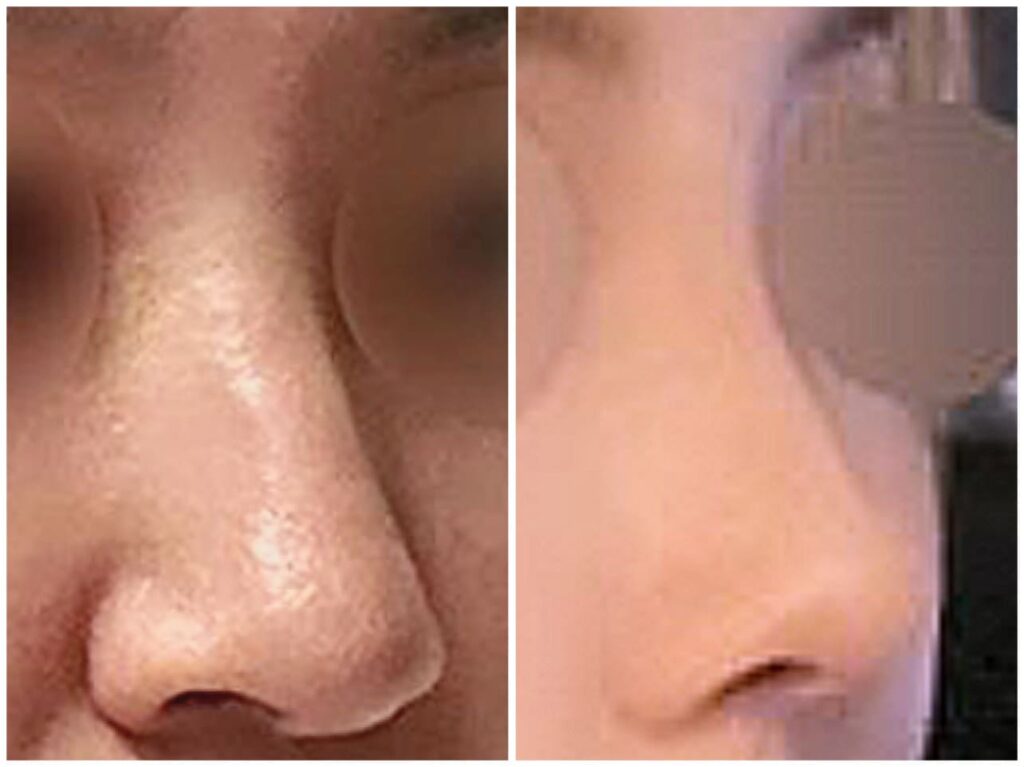 Rhinoplasty_ How It Works in Korea