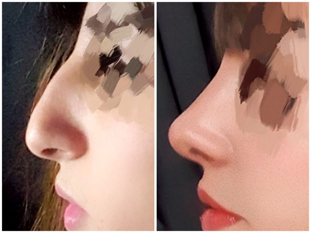 Rhinoplasty_ Resolving the Dorsal Hump Issue in Korea