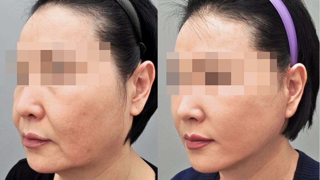 SMAS Lifting vs Traditional Facelift in Korea