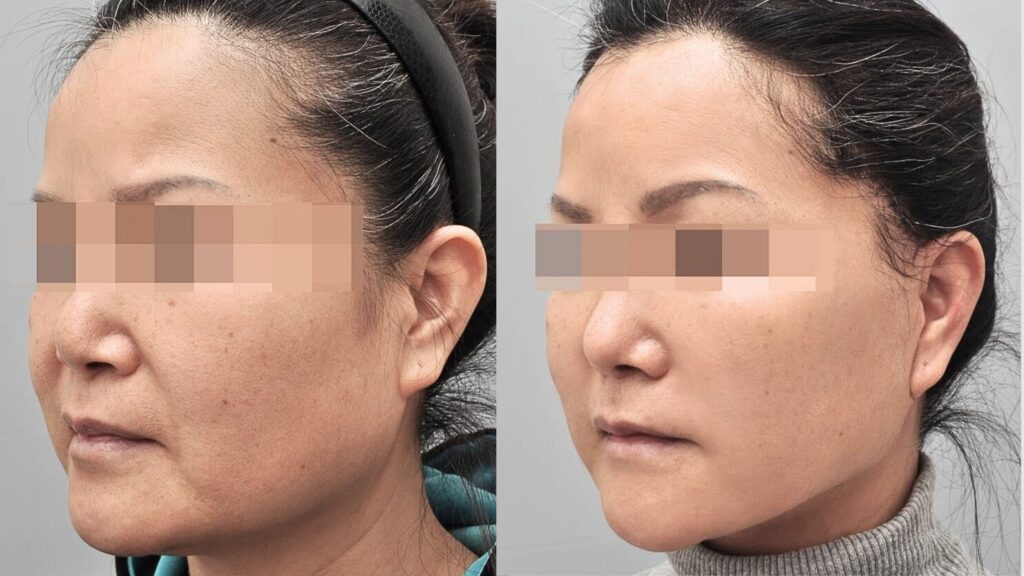 SMAS Neck and Chin Lift in Korea