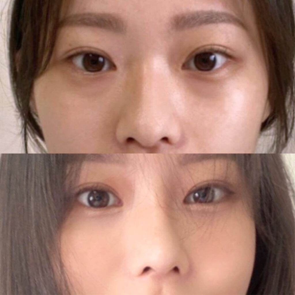 Safe Eye Surgery Techniques in Korea