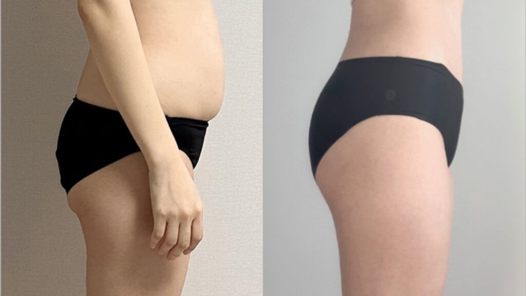 Safety Protocols for Buttock Lipofilling in Korea