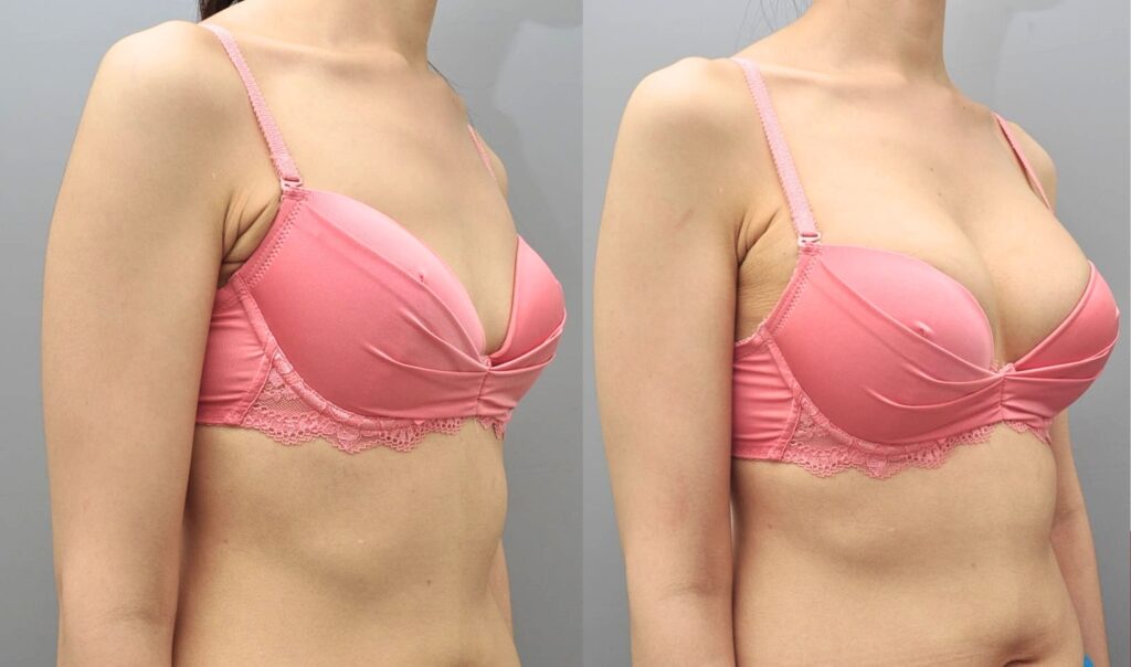 Safety and Effectiveness of Breast Augmentation in Korea