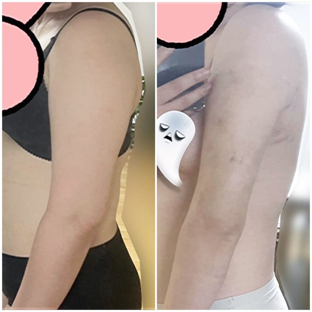 Safety of Arm Liposuction Procedure in Korea