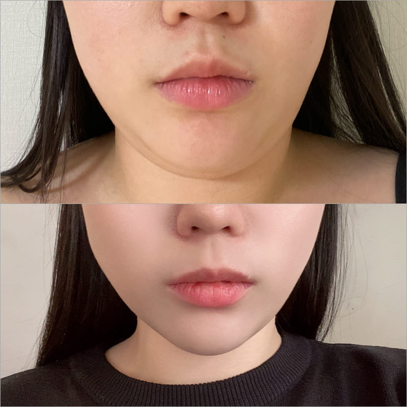 Safety of Face Liposuction Procedure in Korea